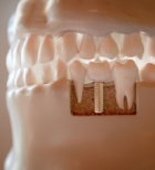 כשאין מספיק עצם בלסת אבל לא מוכנים לוותר על חיוך קבוע: שיטת ההשתלה המפתיעה-תמונה